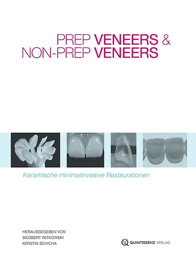 Prep Veneers und Non-Prep Veneers: Keramische minimalinvasive Restaurationen