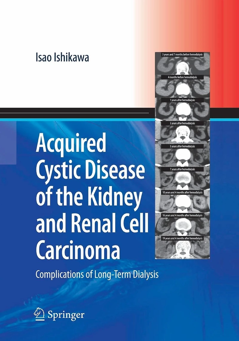 Acquired Cystic Disease of the Kidney and Renal Cell Carcinoma: Complication Long-Term Dialysis