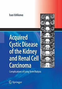 Acquired Cystic Disease of the Kidney and Renal Cell Carcinoma: Complication Long-Term Dialysis