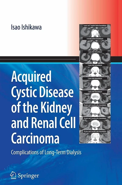 Acquired Cystic Disease of the Kidney and Renal Cell Carcinoma: Complication Long-Term Dialysis