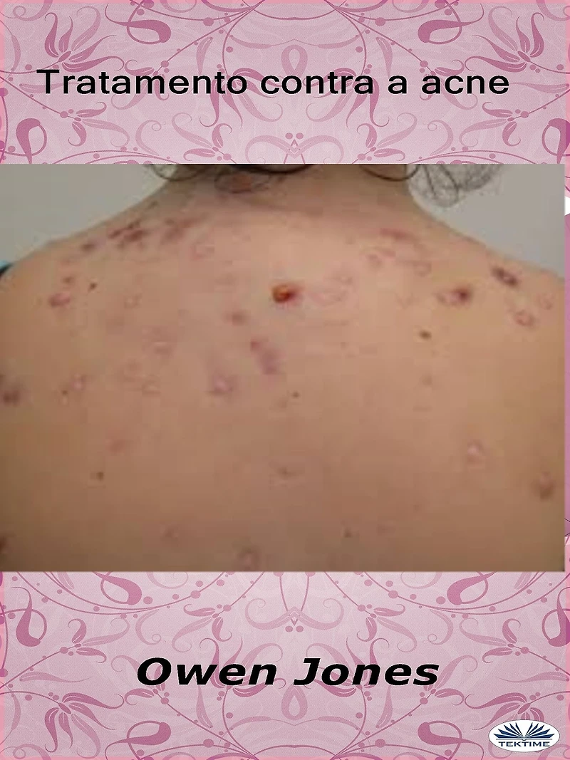 Tratamento Contra A Acne