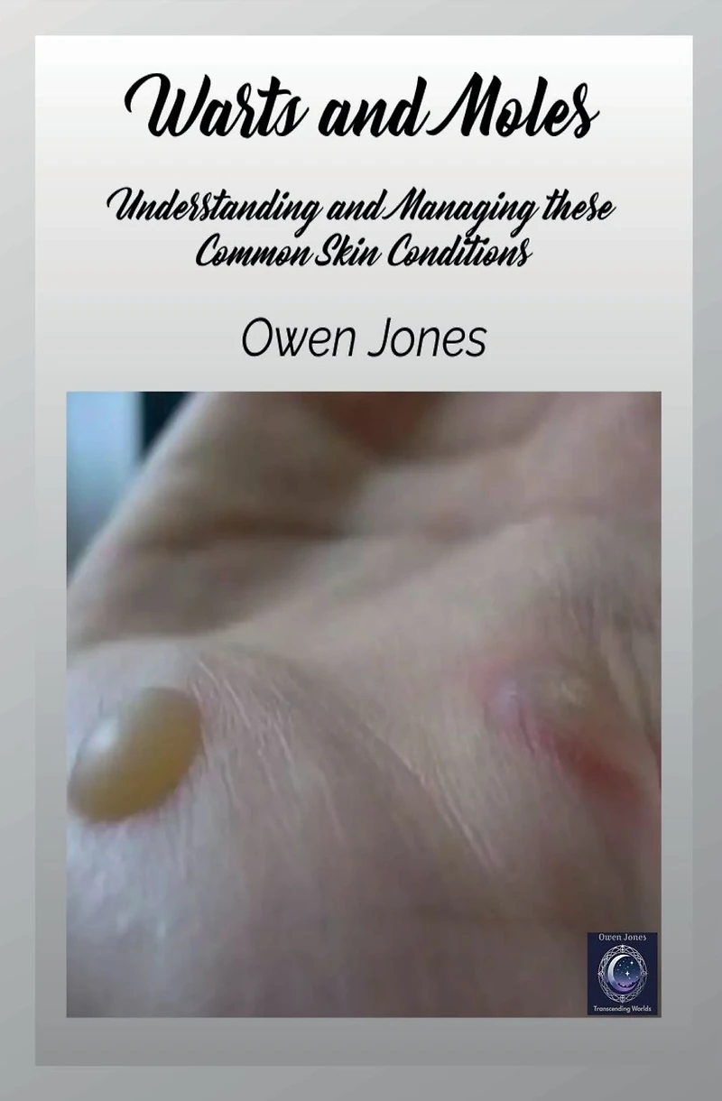 Warts And Moles: Understanding Managing These Common Skin Conditions