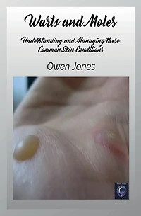 Warts And Moles: Understanding Managing These Common Skin Conditions