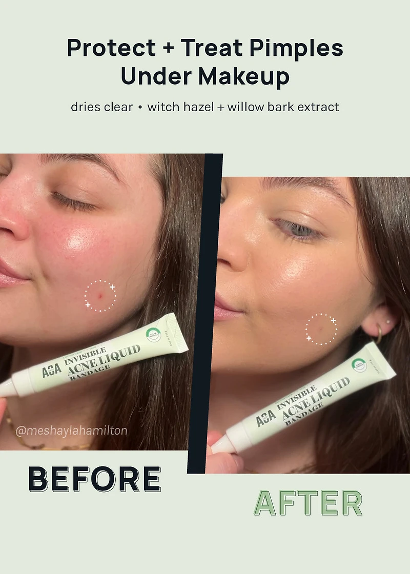 AOA Skin Invisible Acne Liquid Bandage