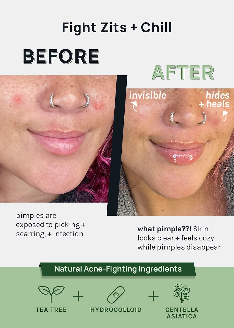 AOA Skin Invisible Acne Patches