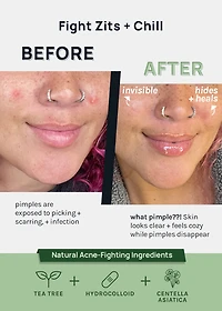 AOA Skin Invisible Acne Patches