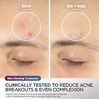 SHARK CryoGlow™ Cooling + LED Face Mask