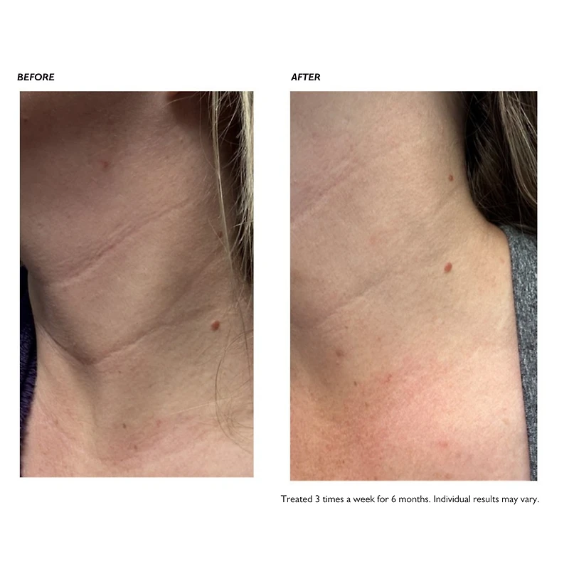 SILK'N LED Neck Mask with Multifunctional Design