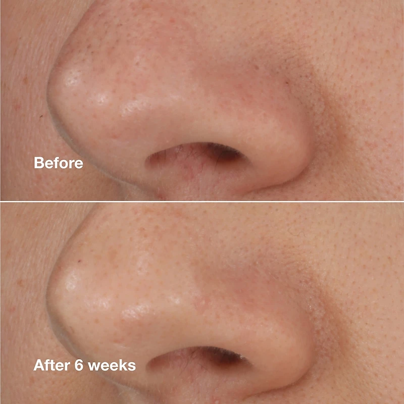Clinique Blackhead Solu Extrac