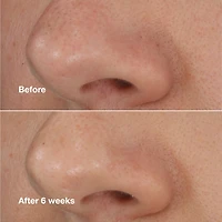 Clinique Blackhead Solu Extrac