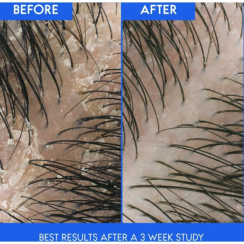 Shampooing et revitalisant 2 en 1 Head & Shoulders pour cuir chevelu qui démange