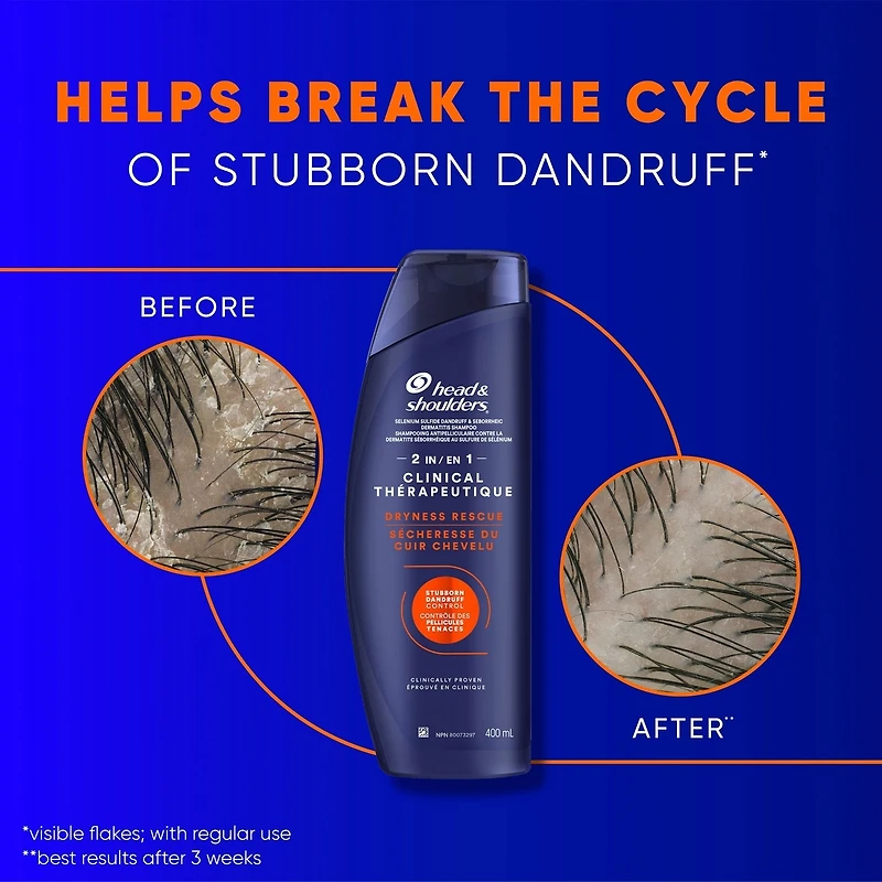 Clinical Dryness Rescue 2in1, for Stubborn Dandruff