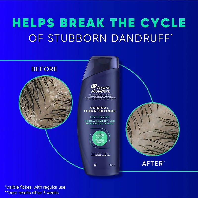 Head & Shoulders Clinical Strength Dandruff Defense Intensive Itch Relief Shampoo, 400 mL