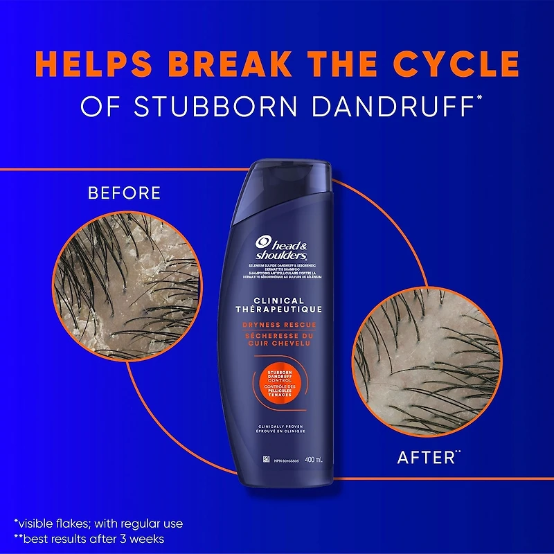 Head & Shoulders Clinical Dry Scalp Rescue Shampoo, 400 mL