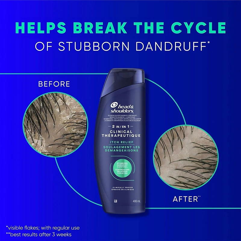 Head & Shoulders Clinical Dandruff Defense Intensive Itch Relief 2in1, 400 mL