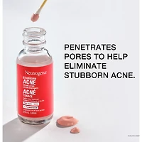 Stubborn Acne Drying Lotion