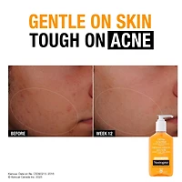 Oil-Free Acne Wash, Fragrance-Free Facial Cleanser