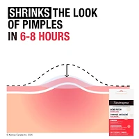 Acne Patches for Sensitive Skin, Two Sizes