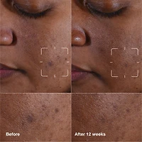 Sérum éclaircissant pour taches brunes Even Better Clinical™ avec vitamine C