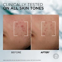 Men Expert Derma Power Acne Face Wash