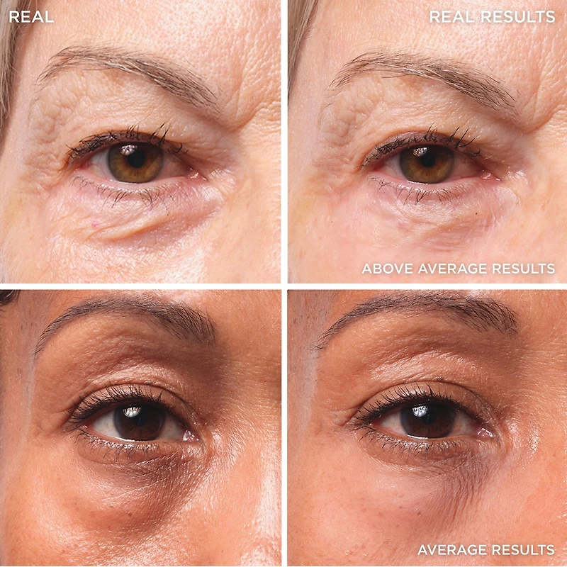 Bye Bye Under Eye - Traitement des poches sous les yeux