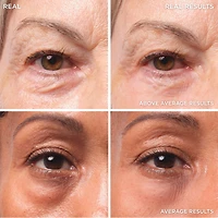 Bye Bye Under Eye - Traitement des poches sous les yeux