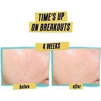 Lotion anti-acné Expertly Clear - Anti-acné quotidien éprouvé en clinique