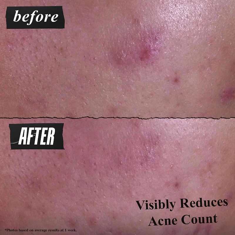 Nettoyant doux efficace pour le traitement contre l'acné