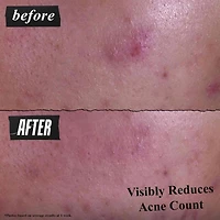 Nettoyant doux efficace pour le traitement contre l'acné