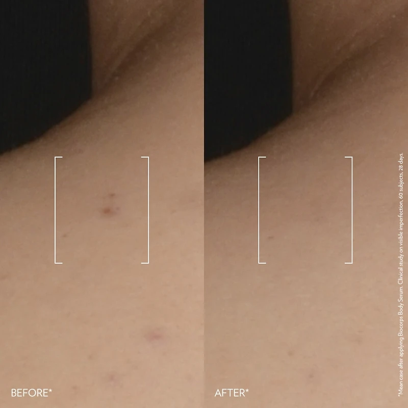 Biocorps Anti-Bump Body Serum For Rough & Bumpy Skin With Hyaluronic Acid