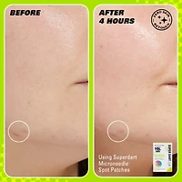 Revolution Skin Super Dart Microneedle Salicylic Acid Hydrocolloid Spot Patches