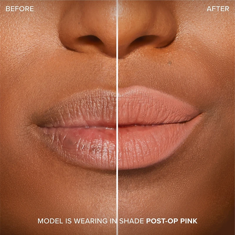 Lip Injection Extreme Shaper