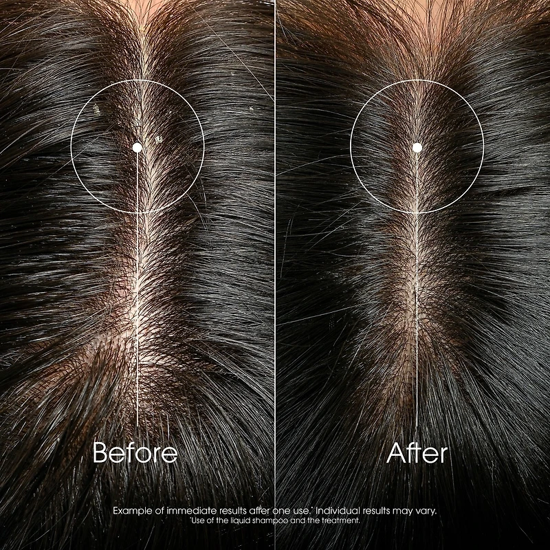 Concentrated Scalp Serum with Galangal - Anti-Loose Dandruff - High tolerance formula - 100 ml