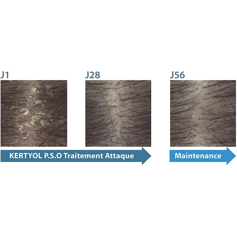 Kertyol PSO shampoo