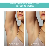 PEACH™ 2 Mint Dispositif Avancé D'épilation à la Lumière Pulsée