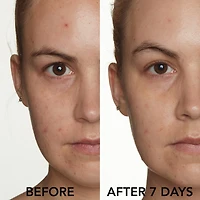 Clarifying Spot Solution with 10% Sulfur + Green Clay