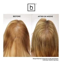 LaserBand 41 ComfortFlex