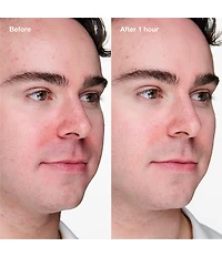 Clinique Acne Solutions Clinical Advanced Clearing Gel with Salicylic Acid