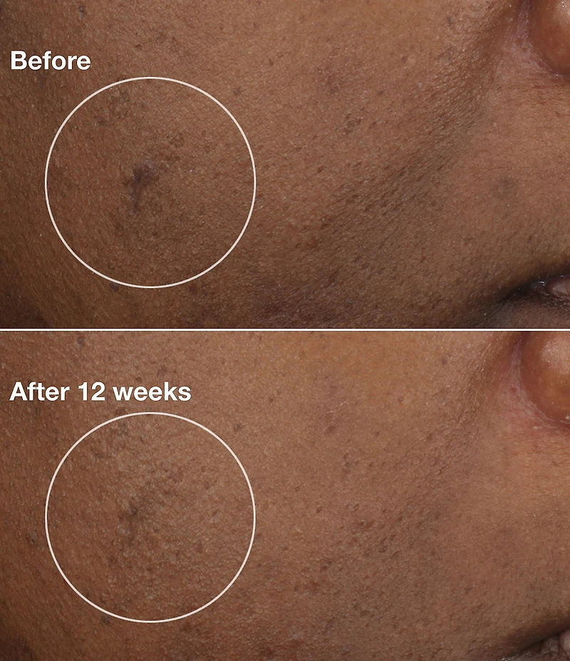 Clinique Brightening Routine: Mini Even Better Skincare Kit