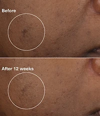 Clinique Brightening Routine: Mini Even Better Skincare Kit