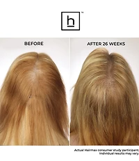 Hairmax LaserBand 41 ComfortFlex