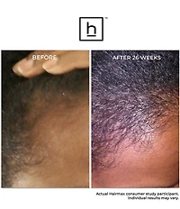 Hairmax LaserComb Ultima 12