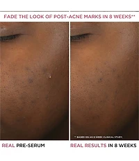 IT Cosmetics Bye Bye Breakout Salicylic Acid Acne Serum