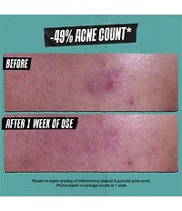 Kiehl's Since 1851 Acne Treating Cleansing Paste