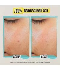 Kiehl's Since 1851 Expertly Clear Acne Treating and Preventing Lotion
