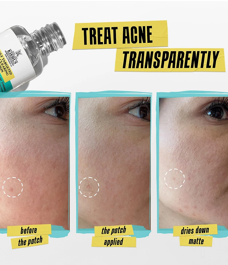 Kiehl's Since 1851 Truly Targeted Acne-Clearing Pimple Patch Solution with Salicylic Acid