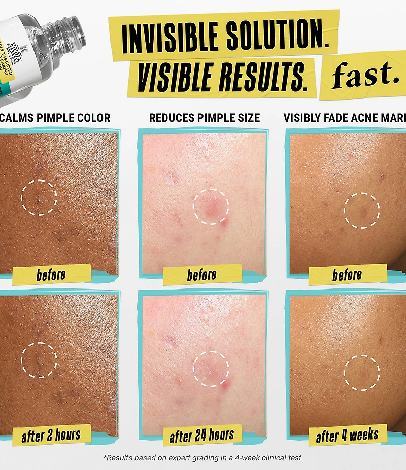 Kiehl's Since 1851 Truly Targeted Acne-Clearing Pimple Patch Solution with Salicylic Acid