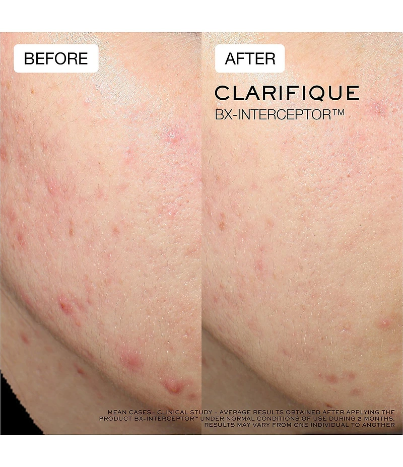 Lancome Clarifique Bx-Interceptor™ Acne Treatment with Glycolic & Salicylic Acid