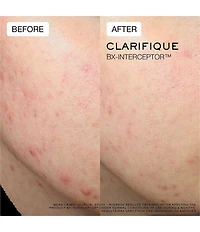 Lancome Clarifique Bx-Interceptor™ Acne Treatment with Glycolic & Salicylic Acid