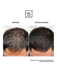 LaserBand 82 ComfortFlex Hair Growth Device